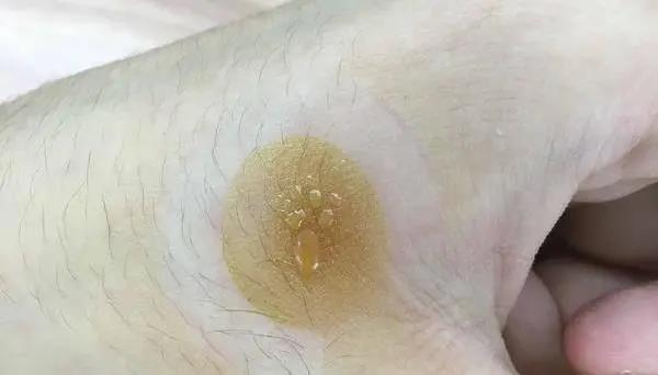 灸花，一種奇妙的花