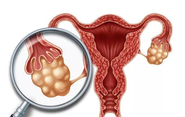 婦科“第一兇癌”！當出現這些癥狀時(shí)，婦科問(wèn)題艾灸灸什么穴位