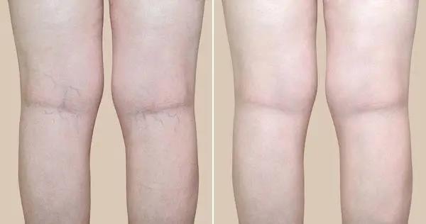 人老腳先衰，木枯根先竭，艾灸不能忘了灸腿！