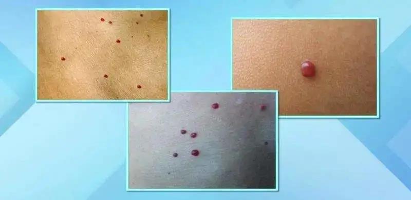 身上莫名其妙的出現血痣，怎么辦？