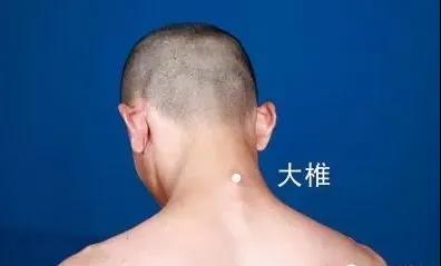 春天灸灸背，能活一百歲~