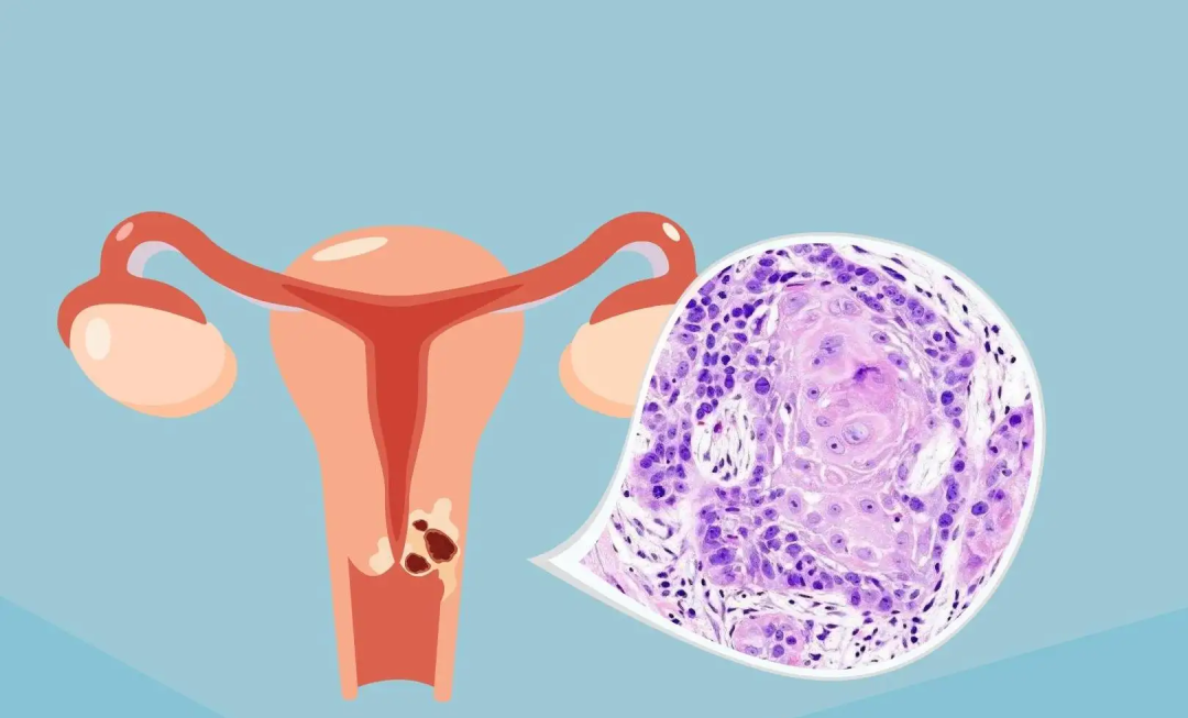 不疼不癢，竟然查出“宮頸癌”！這“3個(gè)信號”要警惕！